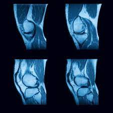 Magnetröntgen av knä